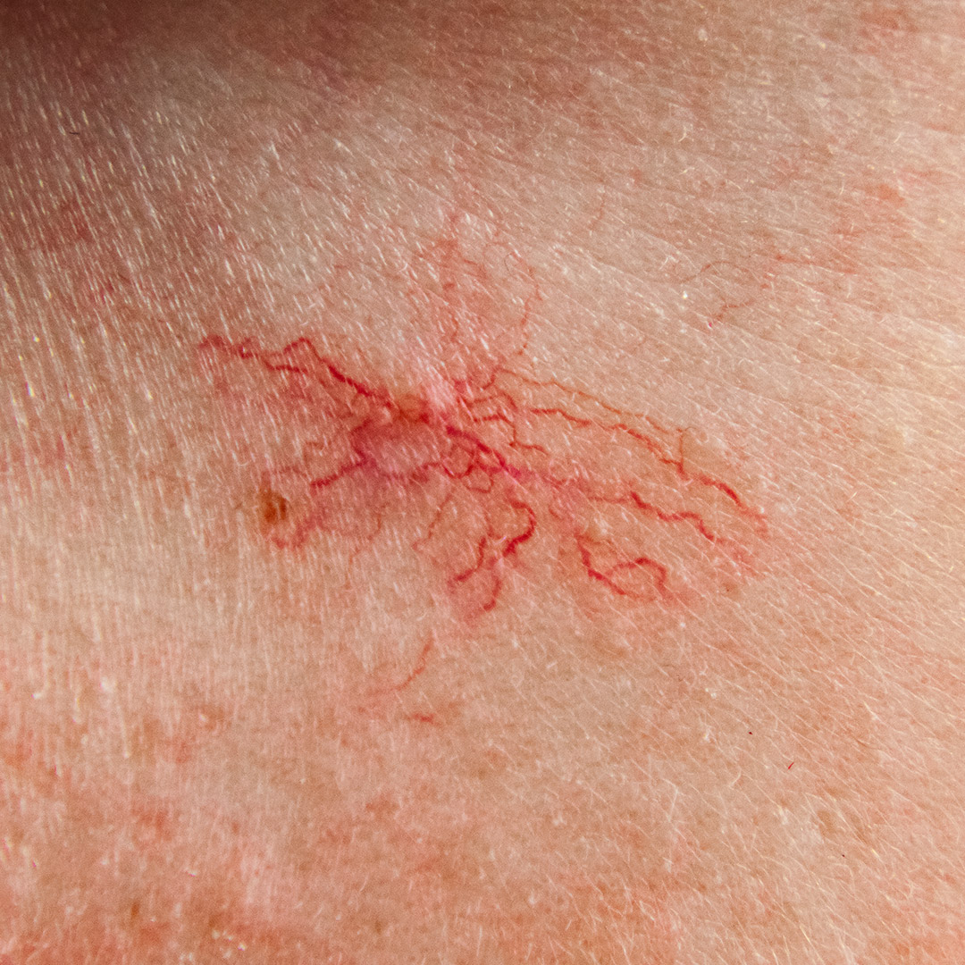 melbourne-cosmetic-laser-clinic-broken-capillaries-face