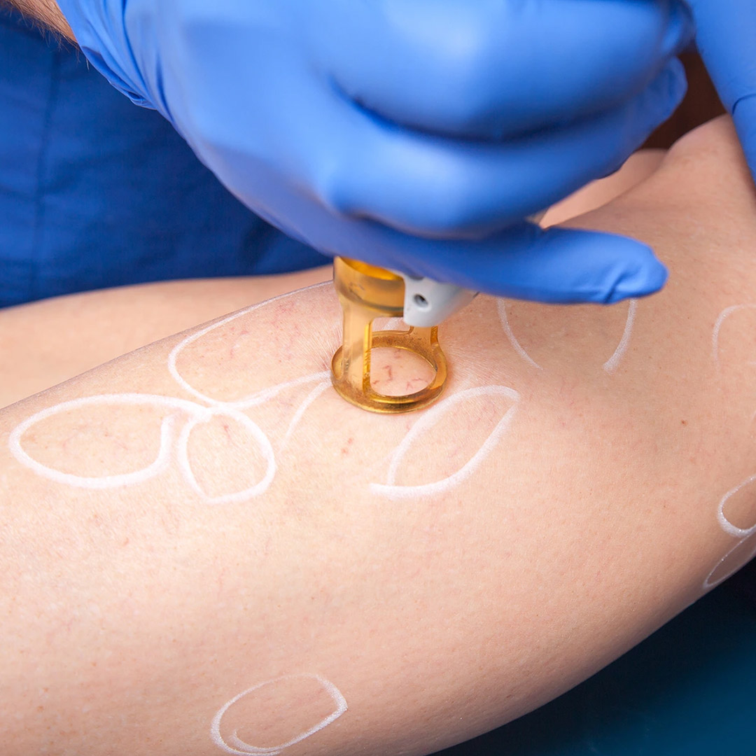 melbourne-cosmetic-laser-clinic-broken-capillaries-treatment-2