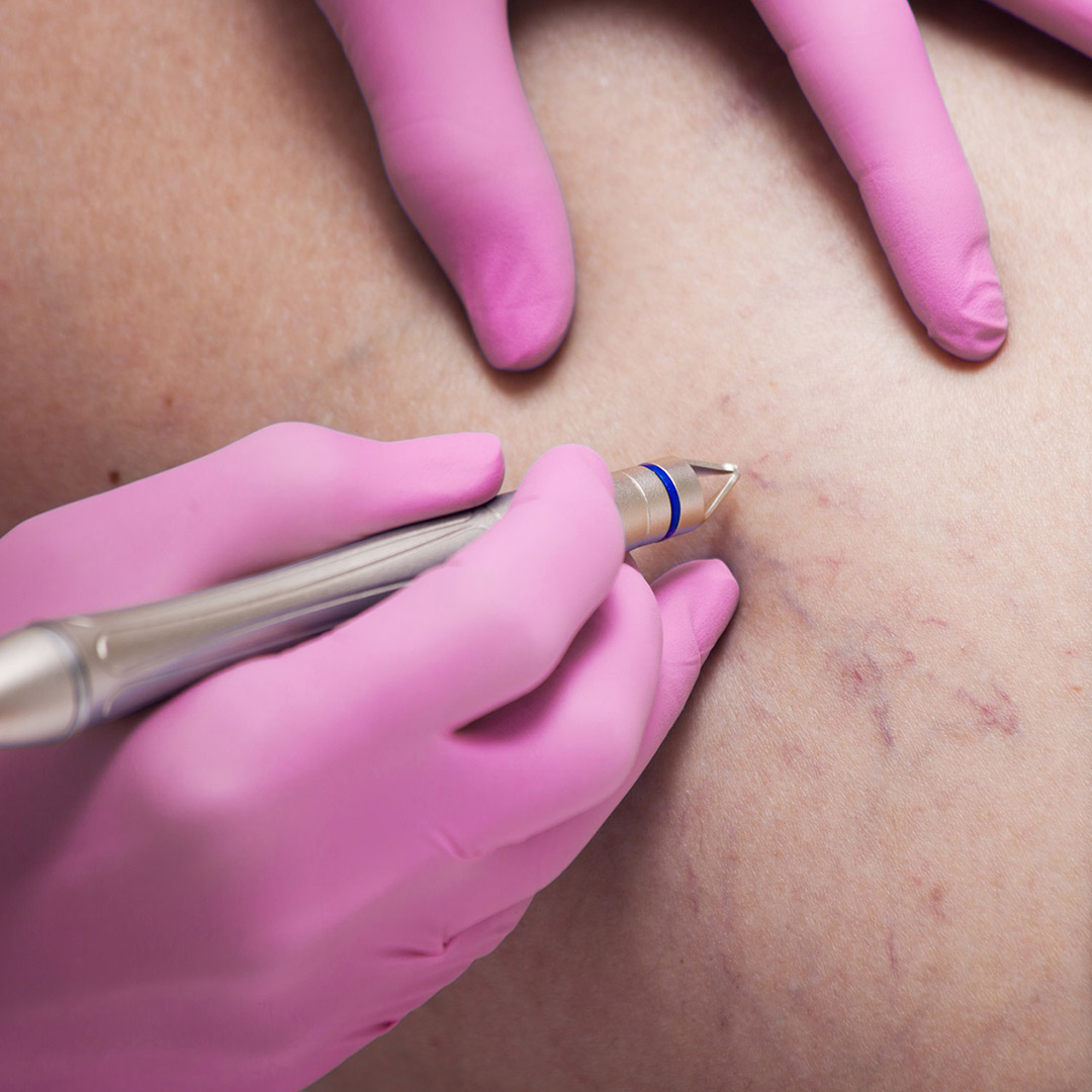 melbourne-cosmetic-laser-clinic-broken-capillaries-treatment