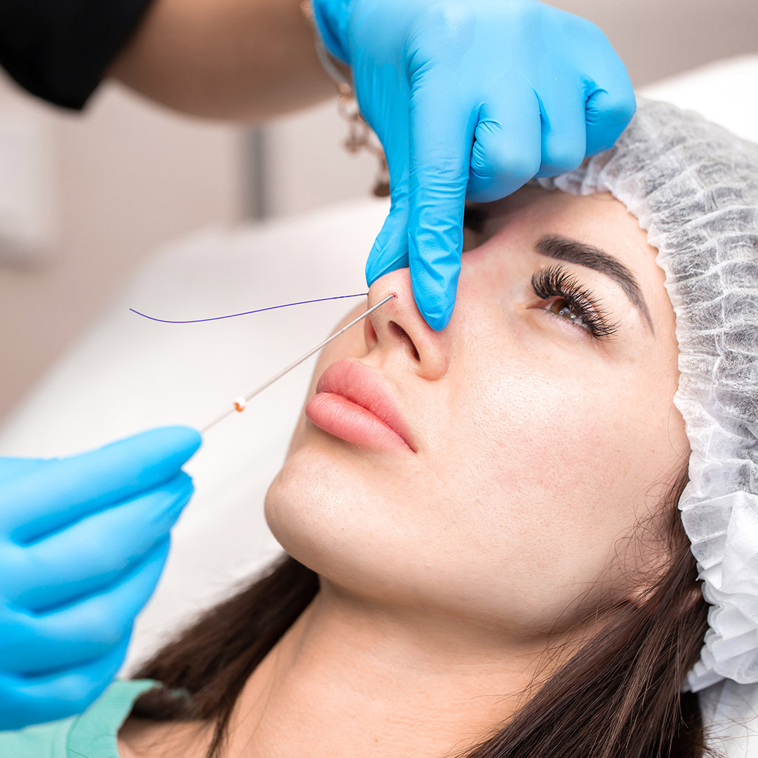 melbourne-cosmetic-laser-clinic-hiko-nose-lift-procedure