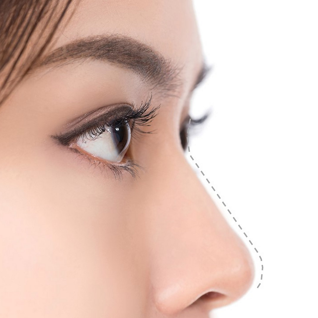 melbourne-cosmetic-laser-clinic-hiko-nose-lift