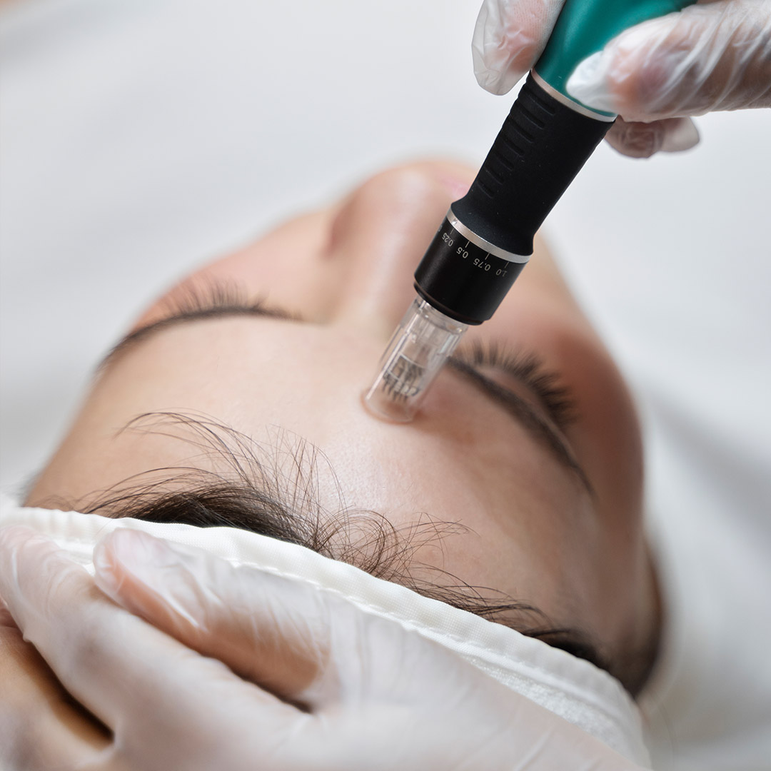 melbourne-cosmetic-laser-clinic-microneedling-procedure