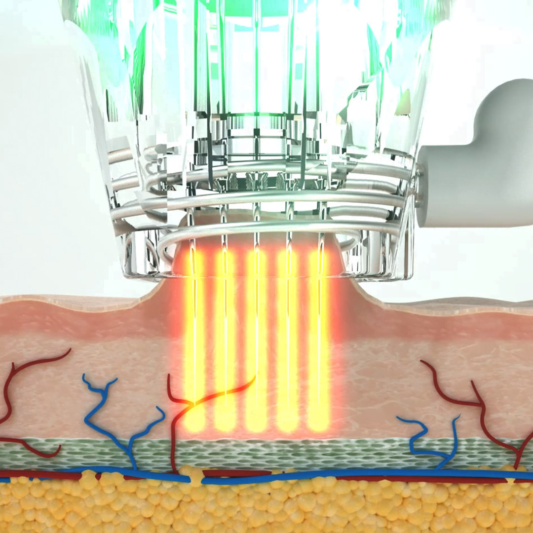 melbourne-cosmetic-laser-clinic-microneedling-technology