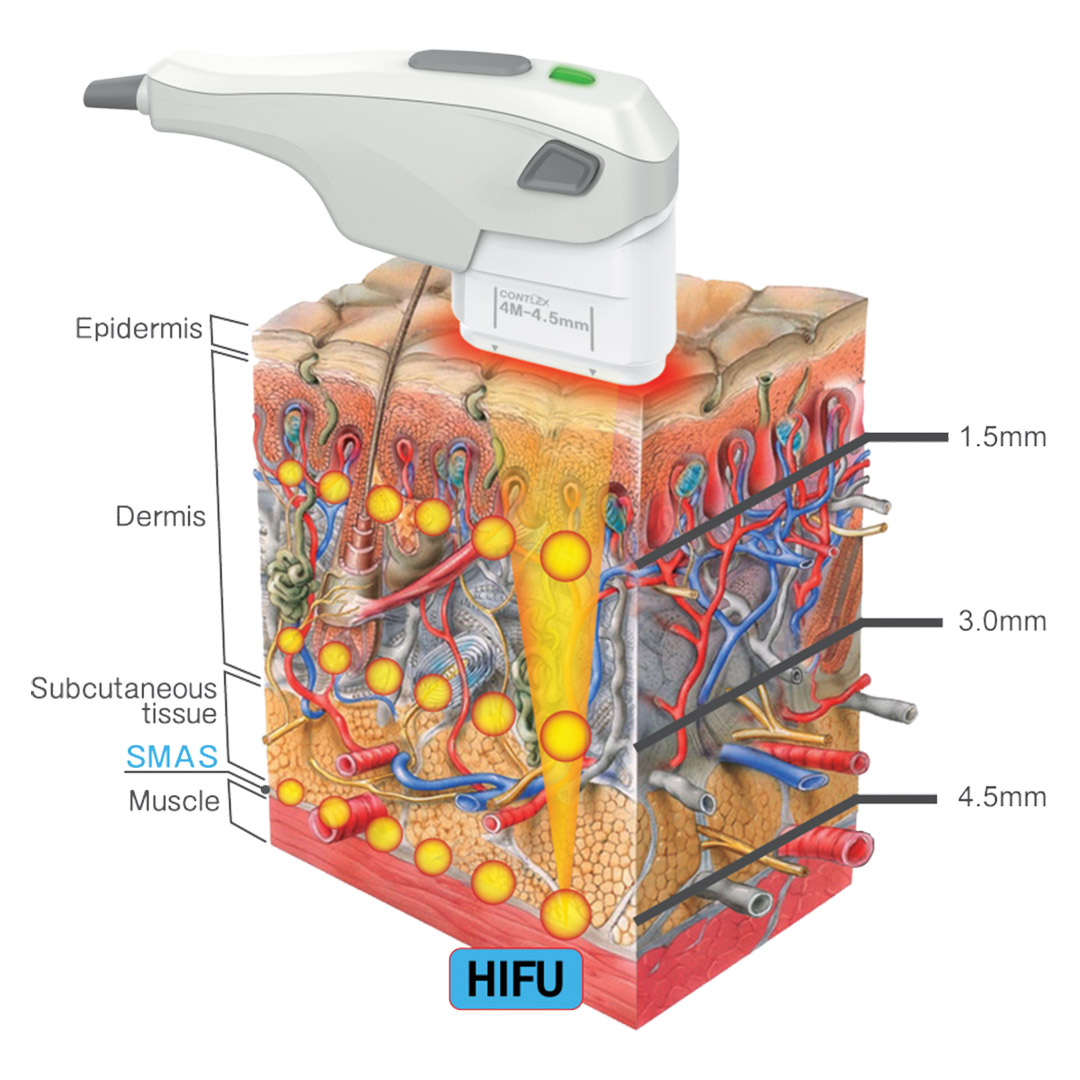 melbourne-cosmetic-laser-clinic-non-surgical-facelift-hifu-technology