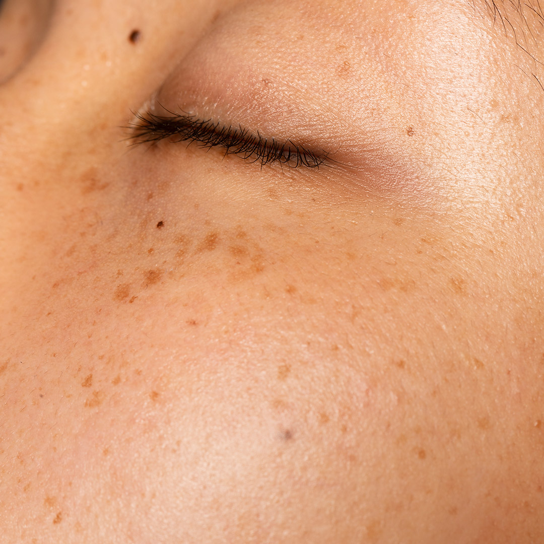 melbourne-cosmetic-laser-clinic-pigmentation-close-up