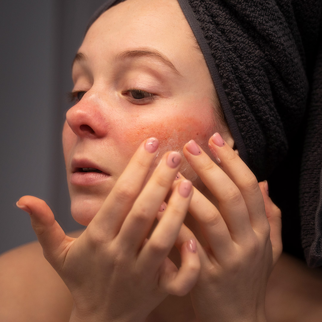 melbourne-cosmetic-laser-clinic-rosacea