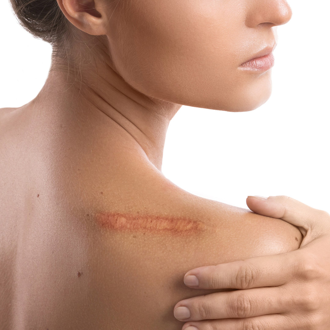 melbourne-cosmetic-laser-clinic-scars