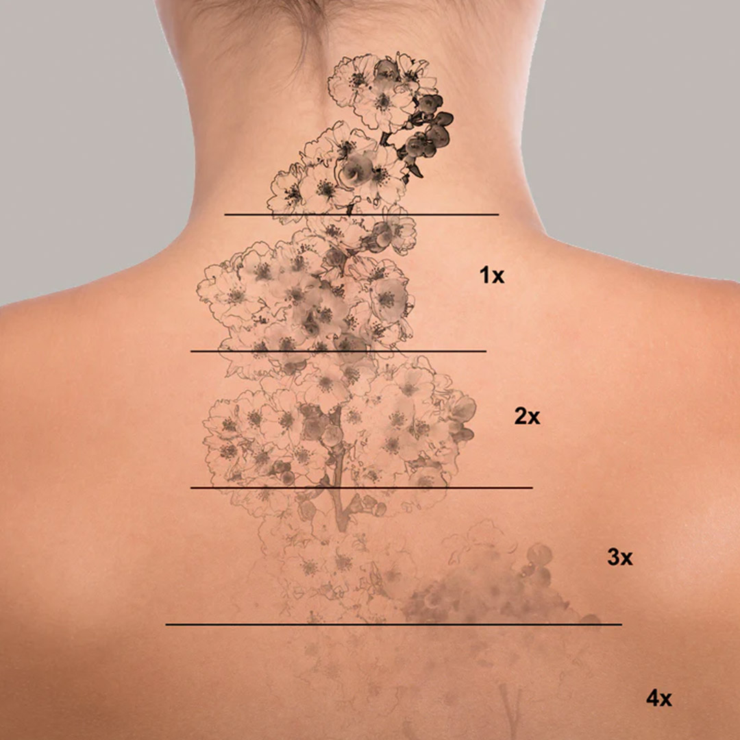 melbourne-cosmetic-laser-clinic-tattoo-removal-chart